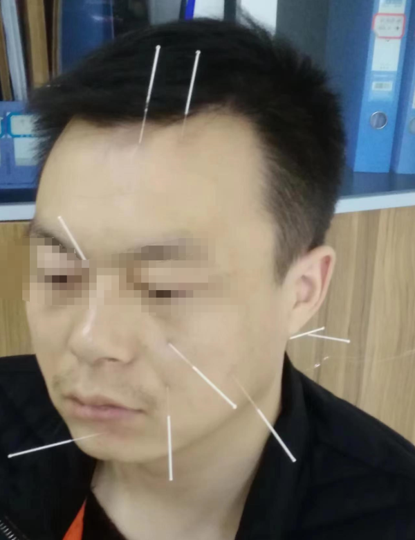 ‌赵院长独到针灸疗法显奇效：张先生面瘫治疗案例