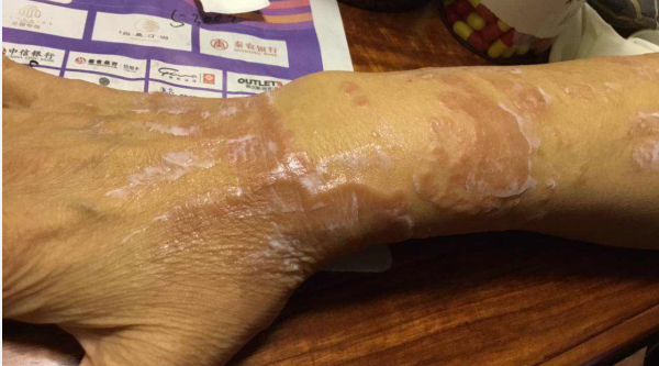 赵院长精准治疗牛皮癣显奇效：手臂皮肤问题迎刃而解