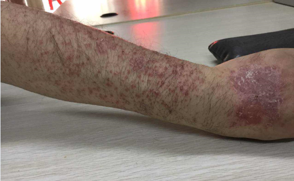 赵院长精准治疗显奇效：男士手臂牛皮癣治好案例