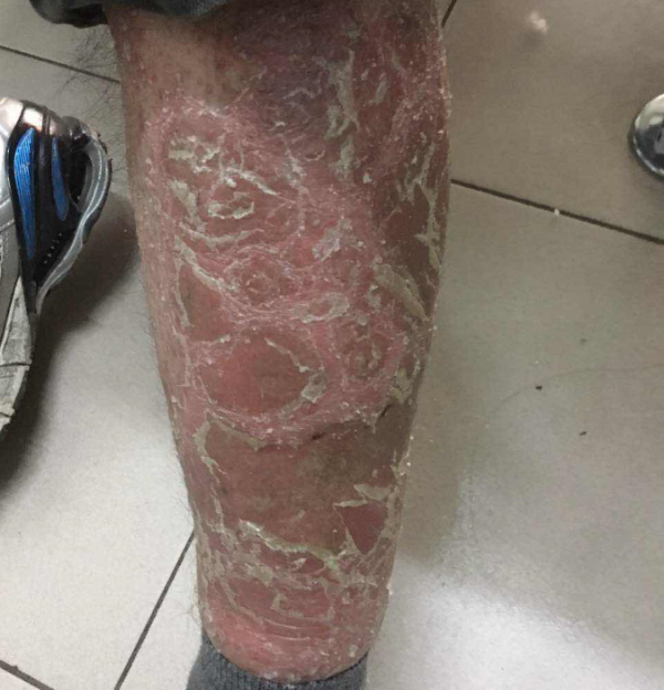 ‌未央同德医院赵院长中医方治好38岁男子多年牛皮癣老烂腿