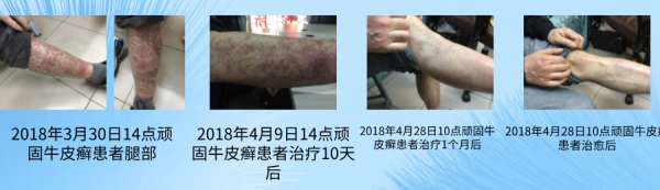 赵院长的牛皮癣中医治疗新思维
