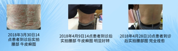 中医治疗牛皮癣效果好