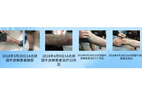 赵院长的牛皮癣中医治疗新思维