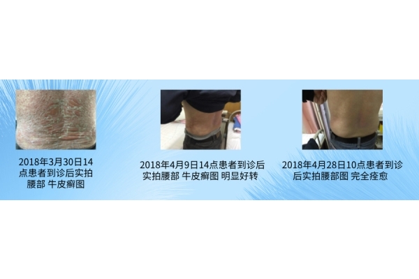 ‌中医系统治疗牛皮癣