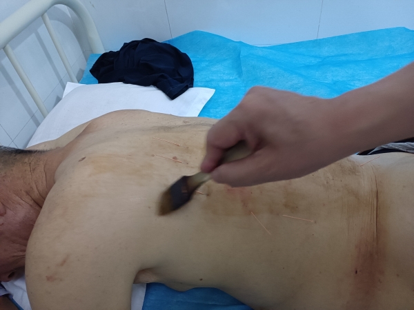 带状疱疹喝中药有用吗